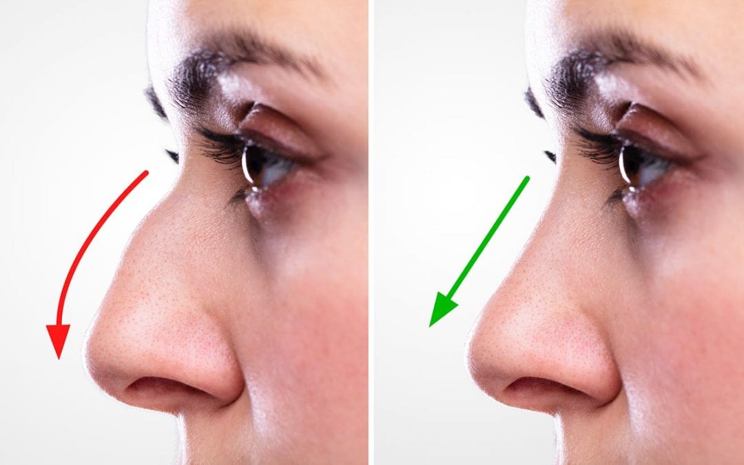 Rhinoplasty Before and After Photos Are Helpful. Find Out Why...