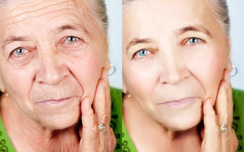 Facelift Before and After